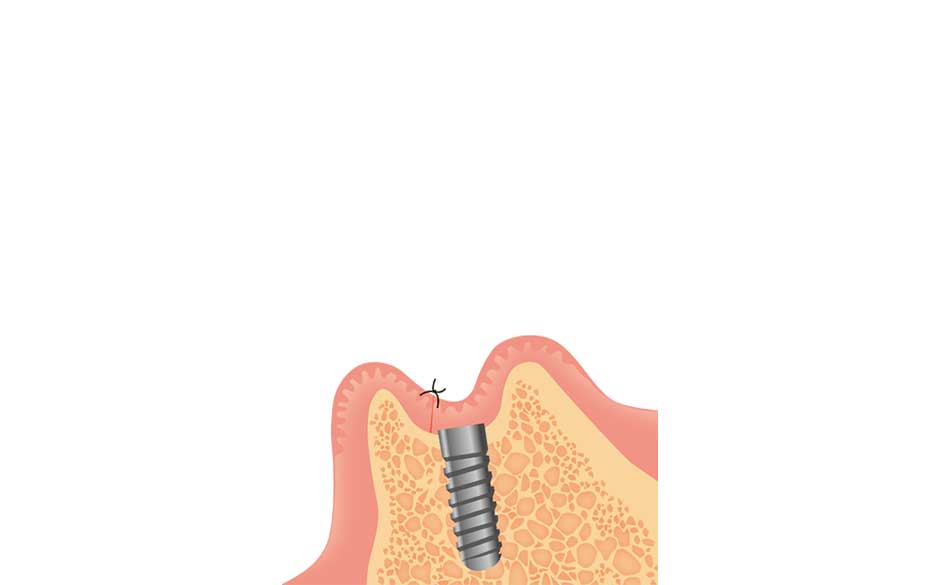 インプラント体の埋入手術