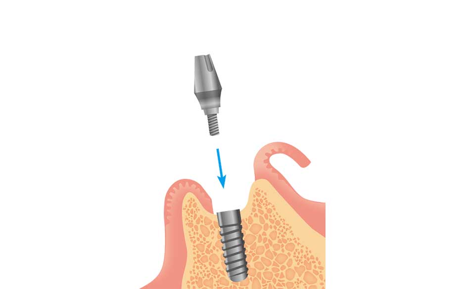 アバットメントの装着
